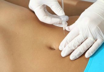 Carboxiterapia Carboxiterapia